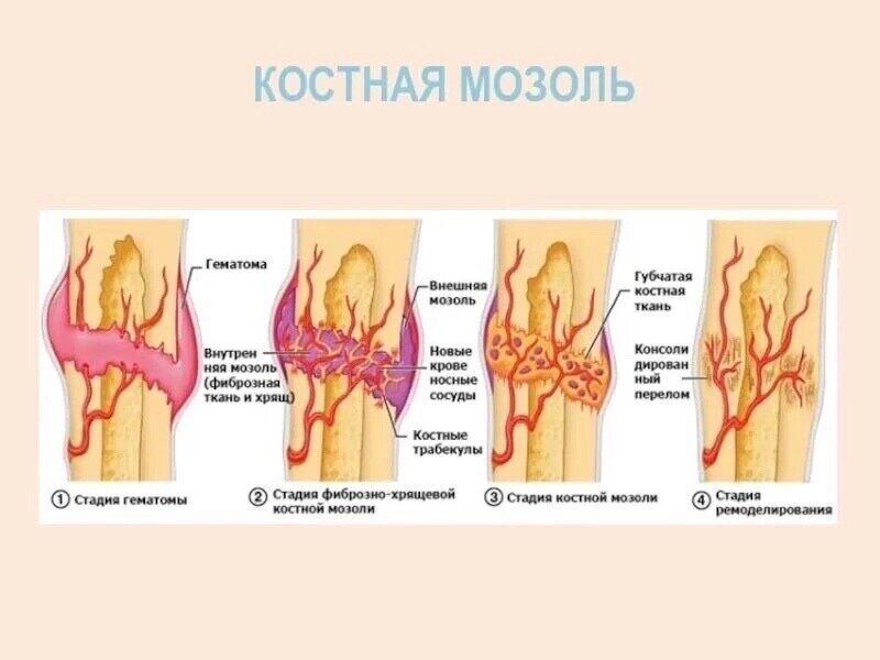 Периостальная костная мозоль