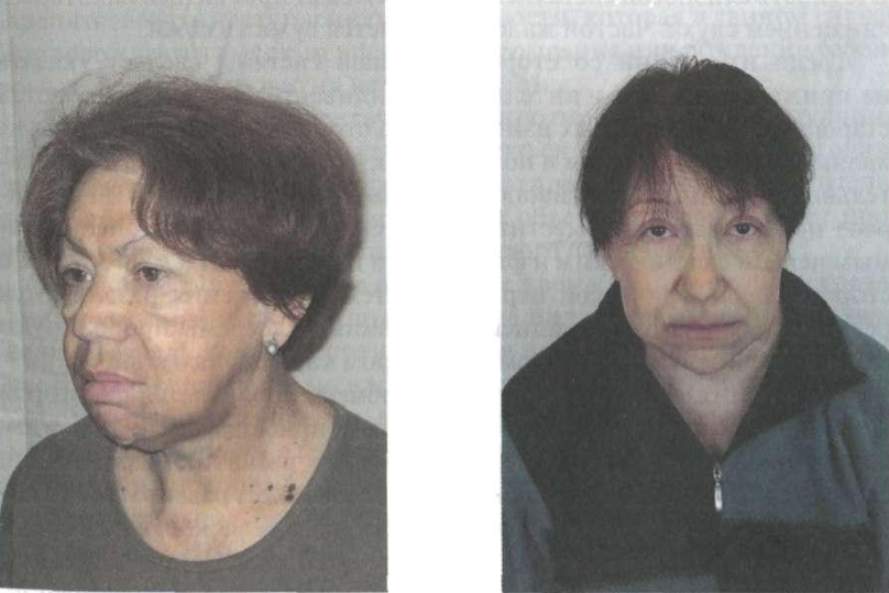 Типичное лицо гипотиреозника: безразличное лицо, тусклый взгляд «в пустоту», одутловатость. Источник: учебник по эндокринологии для врачей И.И. Дедов, Г.А. Мельниченко, В.В. Фадеев.