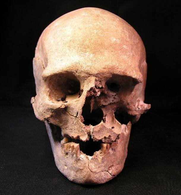 Череп женщины 40-49 лет, похороненной на кладбище Гросс-Фреденвальде.