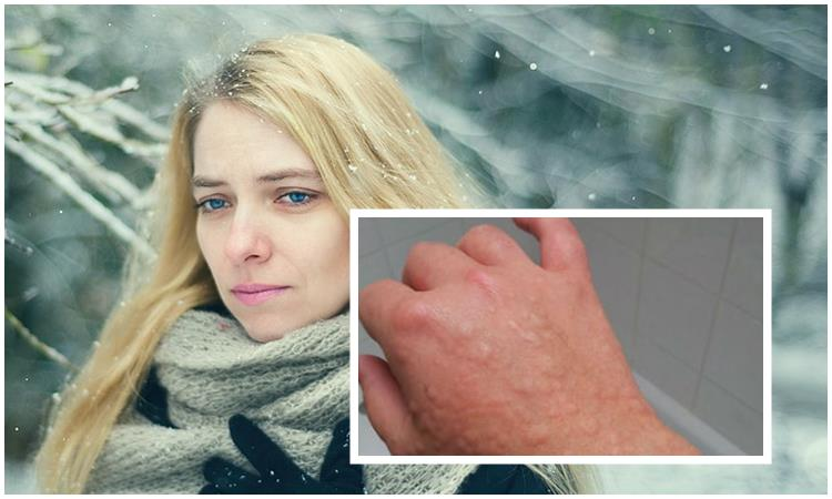 Аллергия на холод: лечение, диагностика, причины, симптомы — 8()