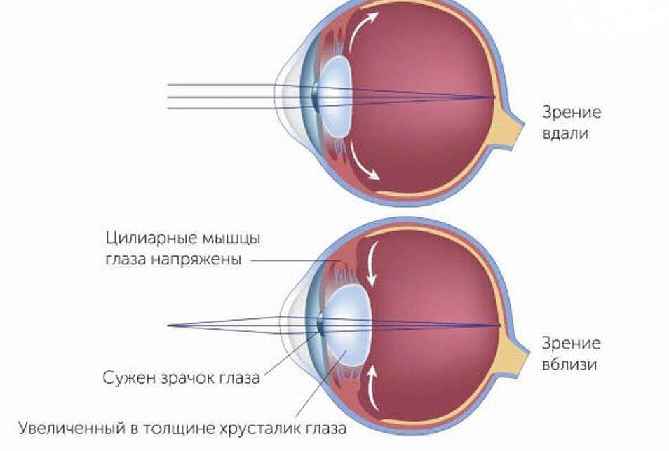 Нарушения рефракции глаз