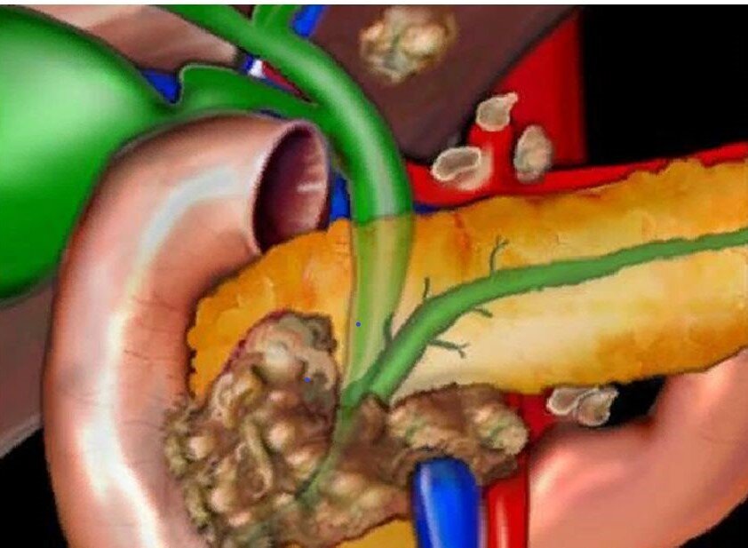 Рак печени и поджелудочной железы презентация