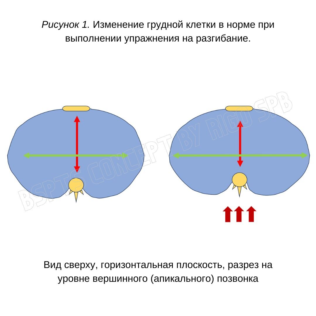Рисунок 1. Изменение грудной клетки в норме при выполнении упражнения на разгибание.