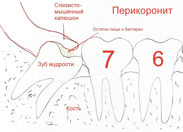 Как выглядит капюшон над зубом мудрости Сага о стоматологии. Глава 57. Что делать если у зуба мудрости воспалился капюшо