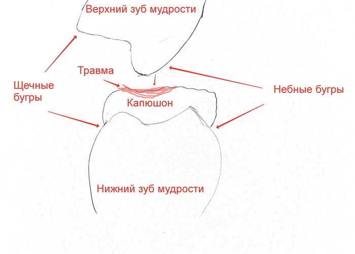 Удаление капюшона над зубом при перикороните