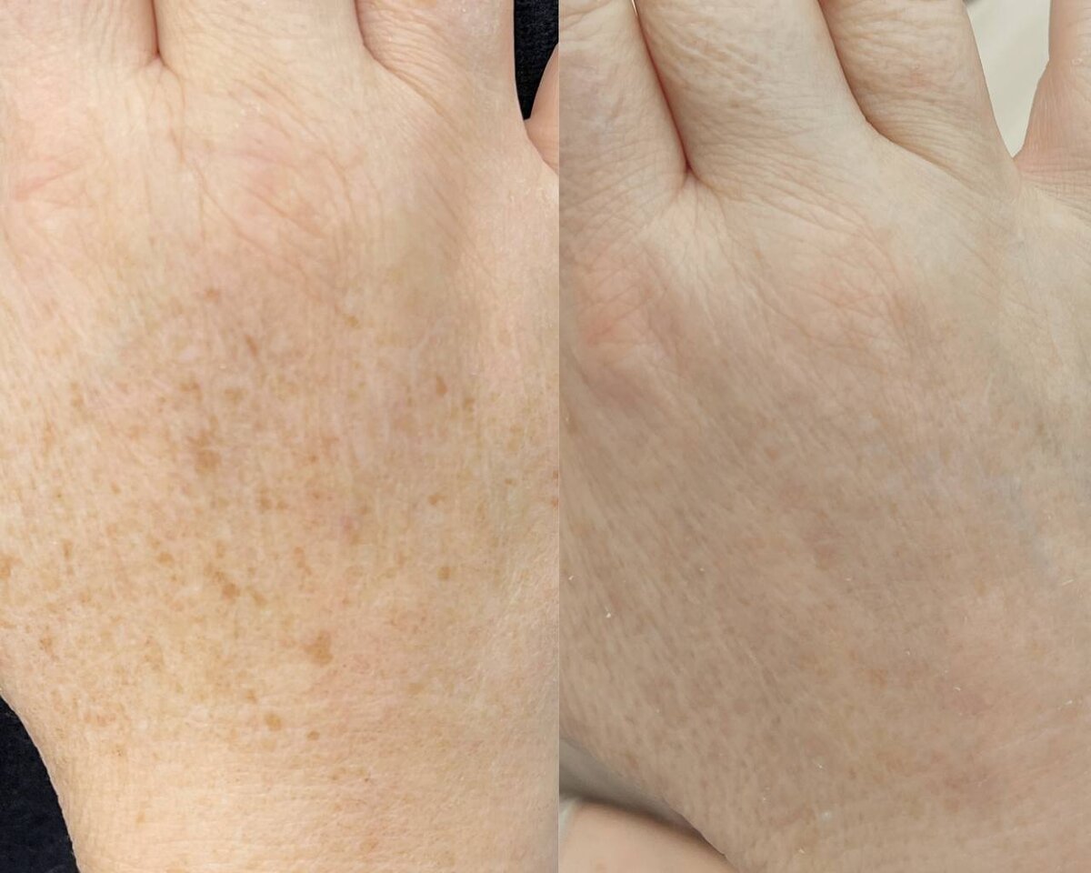 Иванов В.С. Клиника InFacial. Омоложение кистей рук, 1 процедура. 