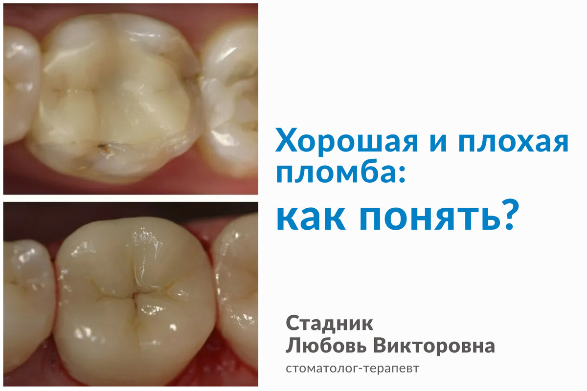 Сверху на фото пример неудачной пломбы.