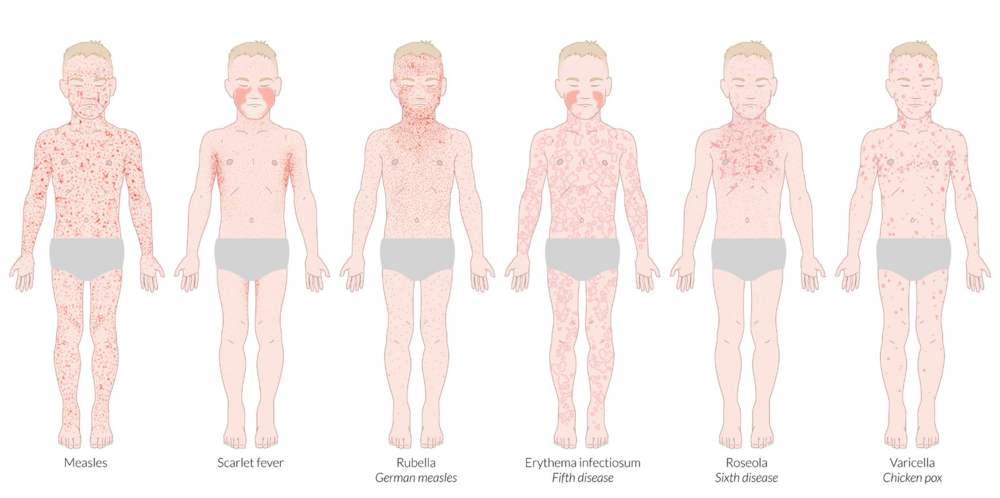 Сыпь отличия. Корь краснуха крапивница ветрянка. Краснуха корь скарлатина сыпь. Корь краснуха ветрянка скарлатина сыпь таблица. Корь сыпь краснуха скар.