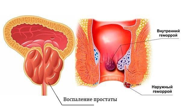 Геморрой и простатит – наказание за блага цивилизации и успехи в карьере