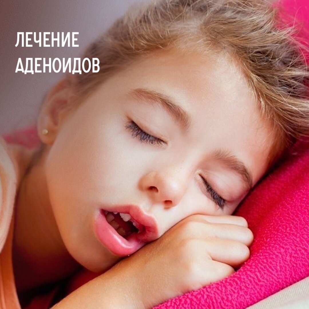 лечение аденоидов
