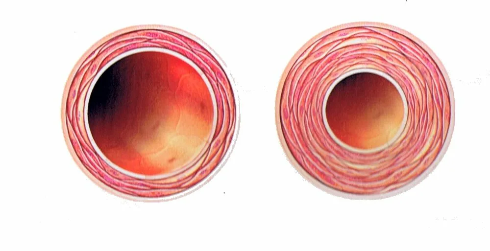 Уплотнение эпителия.