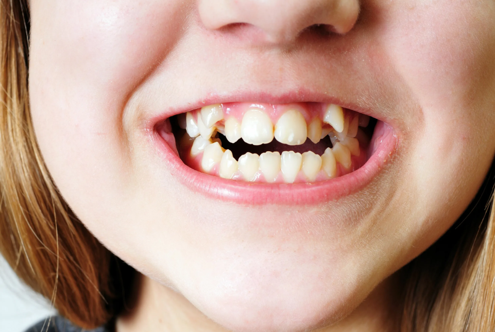 двойная челюсть у человека. двойная челюсть у человека. челюсть вид сверху. пластическая операция на подбородок. перекрестный прикус члх.