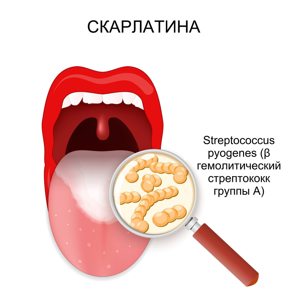 Скарлатина у детей