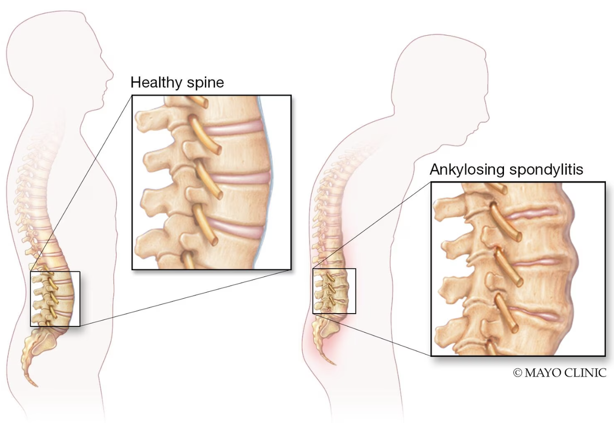 Здоровый позвоночник/анкилозирующий спондилоартрит