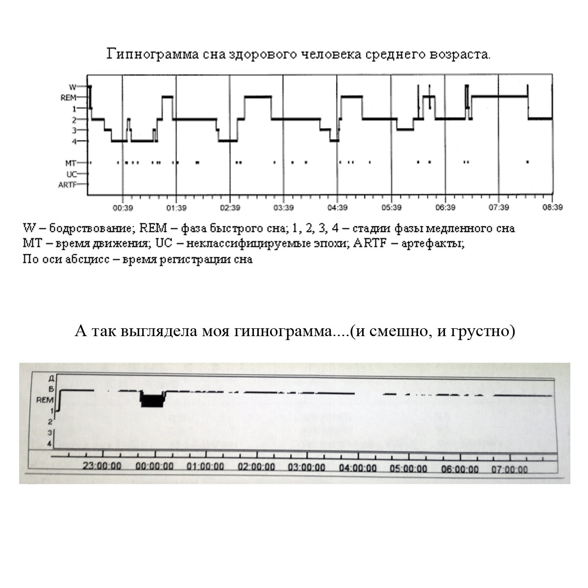 Результаты моей полисомнографии