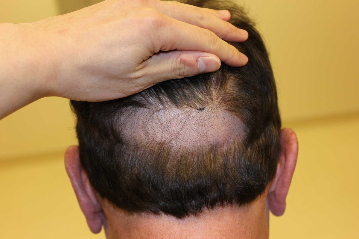 Трихотиломания это. Очаговая алопеция (alopecia Areata). Каррамбэйби трихотилломания.