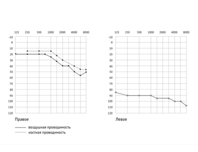 Сделать аудиограмму в спб. Аудиограмма сенсоневральная глухота. Графическая аудиограмма. Речевые частоты на аудиограмме. График нормальной аудиограммы.