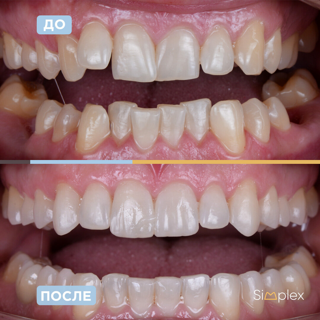 Исправление прикуса на элайнерах. Врач-ортодонт Бажанова О.В.