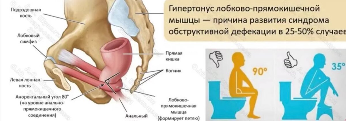 Анальная трещина лечение и симптомы