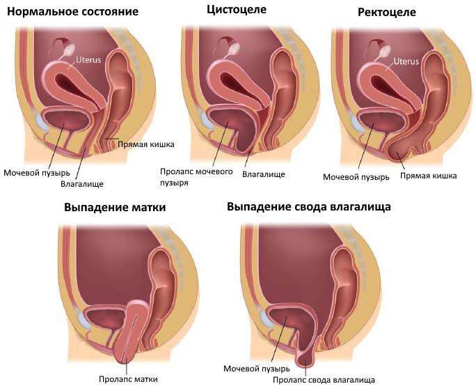 Выпадение влагалища и матки: причины, симптомы, последствия и осложнения