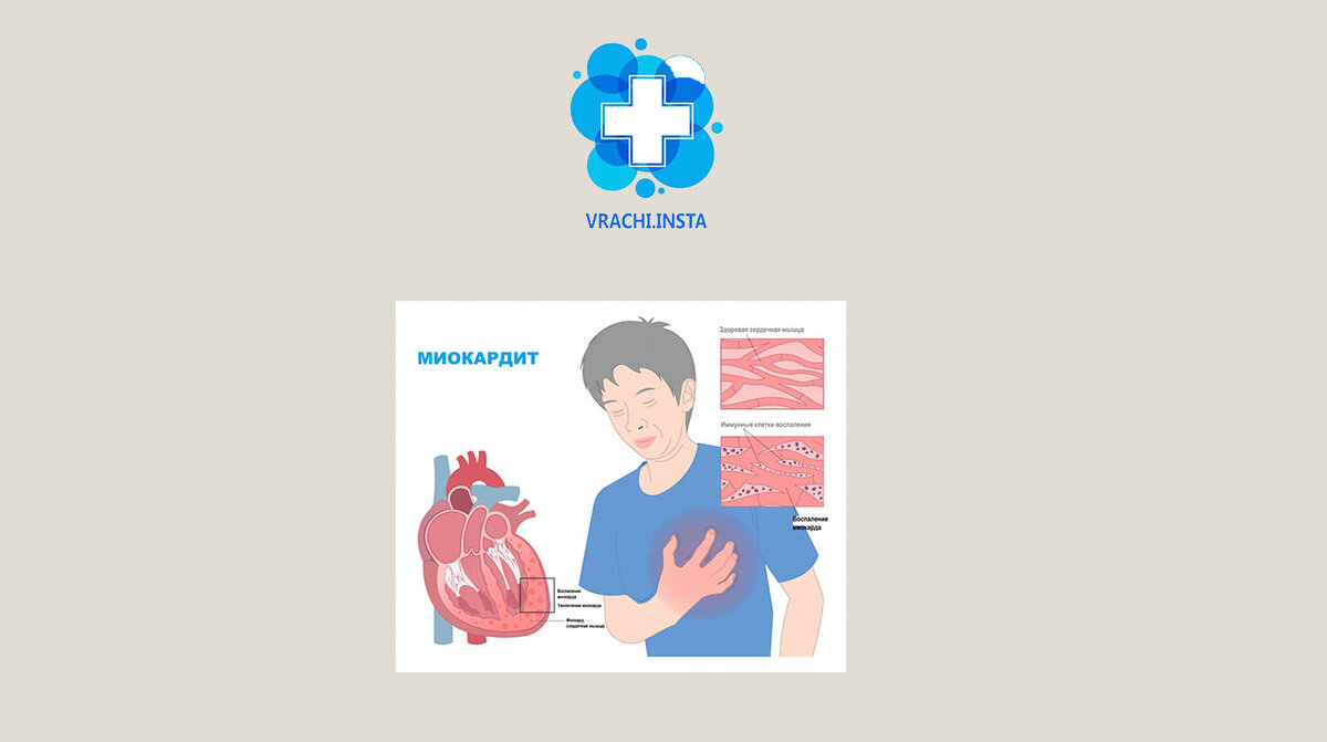Обычное банальное ОРВИ может привести к серьезному заболеванию сердца, как  миокардит. ⁣⁣⠀ | Vrachi.insta | Дзен