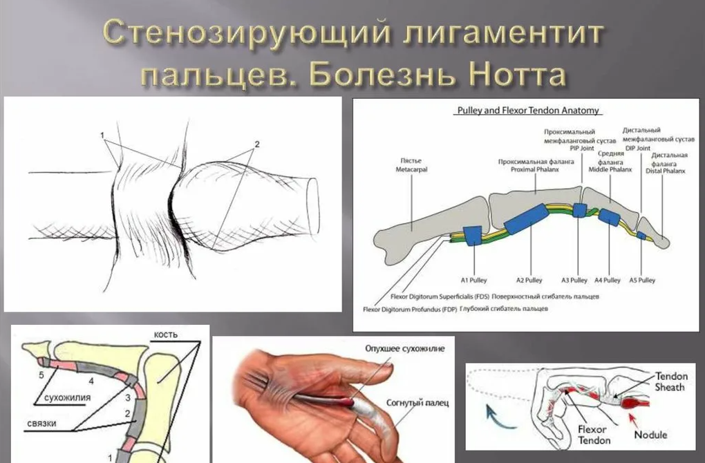 Болезнь нотта что это. Стенозирующий лигаментит пальца. Стенозирующий лигаментит пальца кисти. Болезнь Нотт,стенозируюший ЛЕНГО.