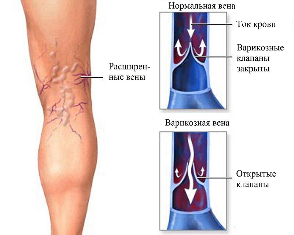 Венозные, почечные или сердечные — в чем причина отеков? | Evolutis Clinic  | Дзен