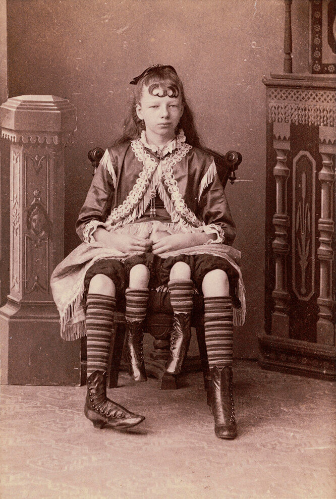 Девушка с двумя органами. Жозефин Миртл Корбин (Техас, 1868-1928). Жозефина Миртл Корбин женщина