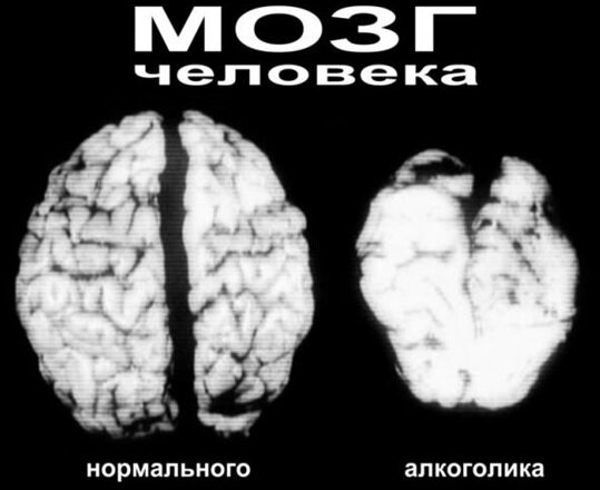 Сравнение объёма головного мозга здорового человека и алкоголика