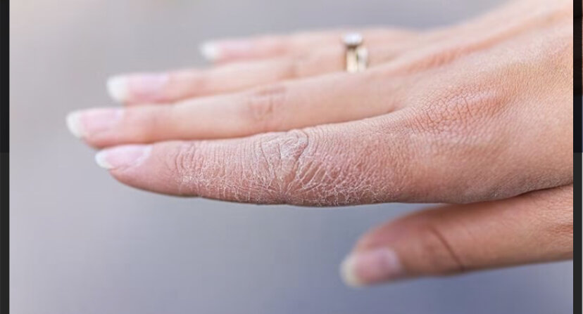 Экзема. Простые правила. | Skinhacking - больше, чем просто о коже | Дзен
