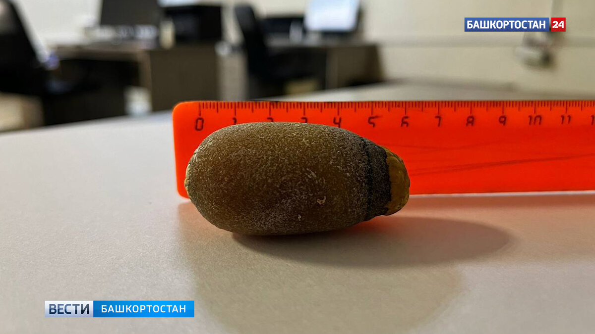    Жительнице Башкирии удалили желчный пузырь с камнем размером с куриное яйцо