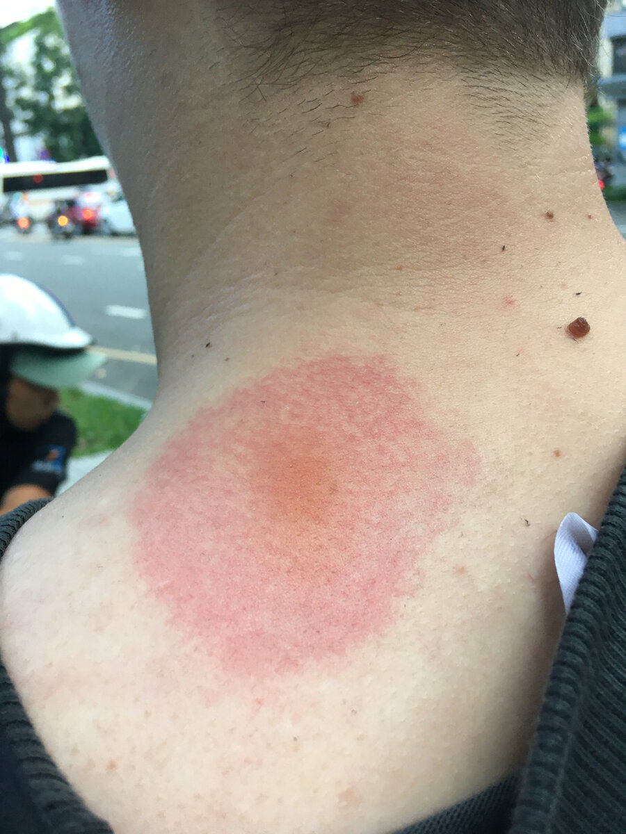 Спустя пару минут после укуса