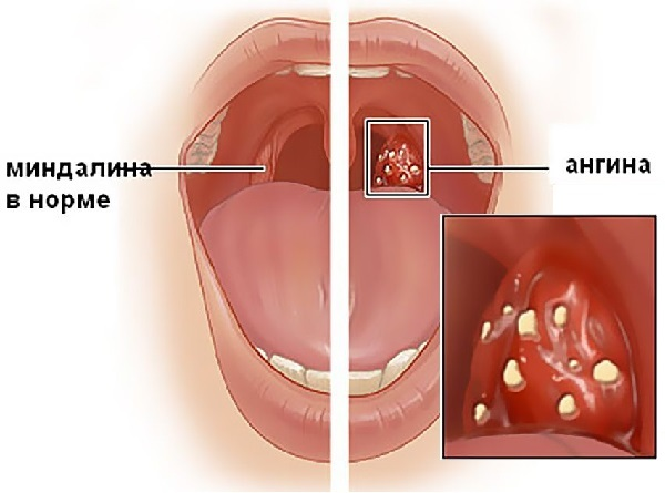 Симптомы и лечение стоматита