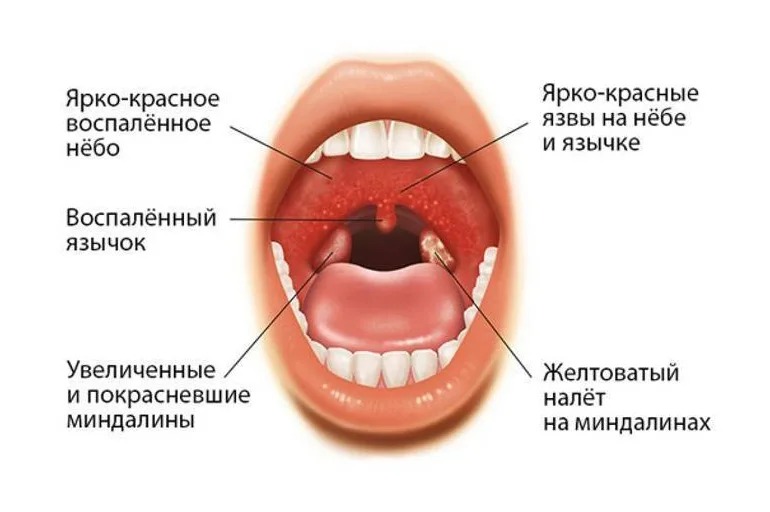 Не могу глотать