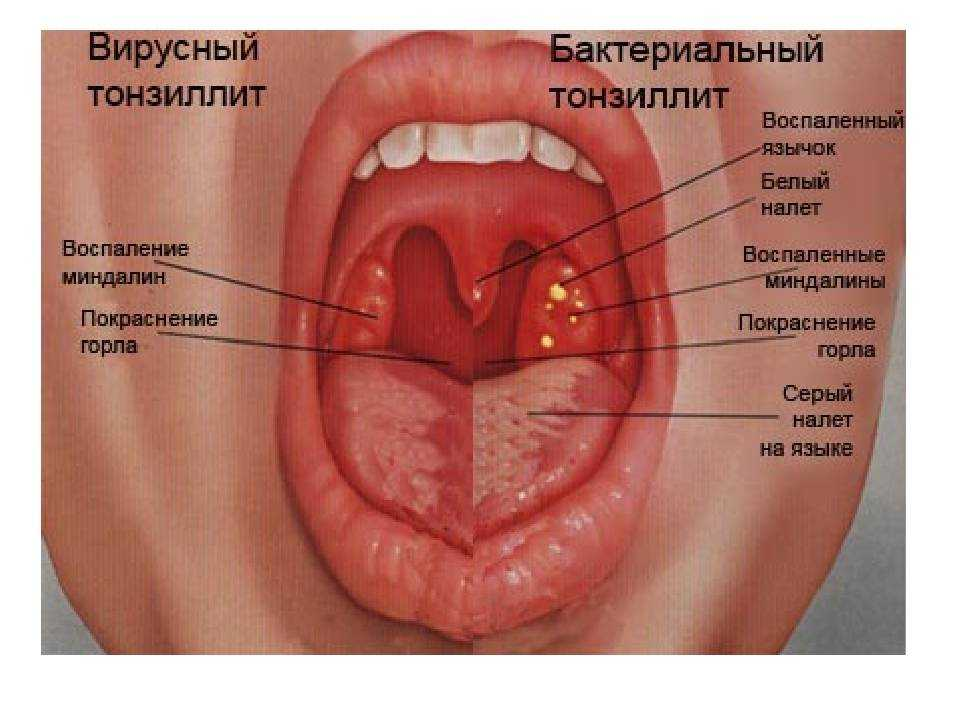 Першение в горле - причины появления, симптомы заболевания, диагностика и способы лечения