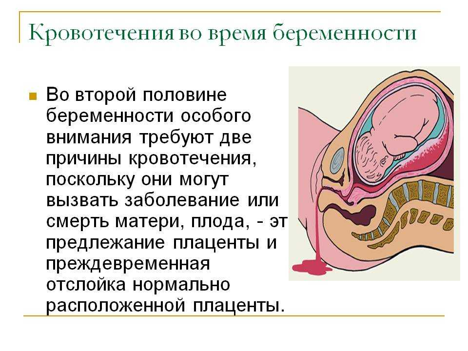 Маточное кровотечение - симптомы, лечение, как остановить