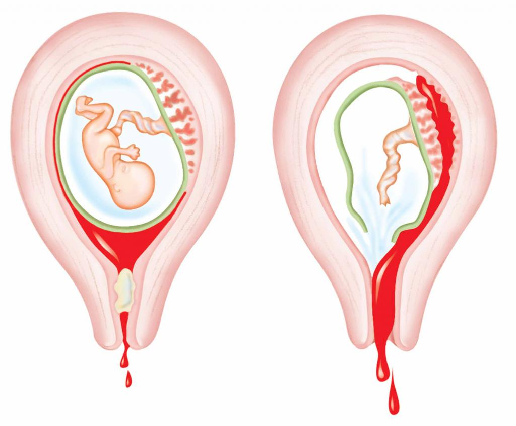 Кровь после выскабливания матки. Самопроизвольный абор. Самопроизвольное прерывание беременности.