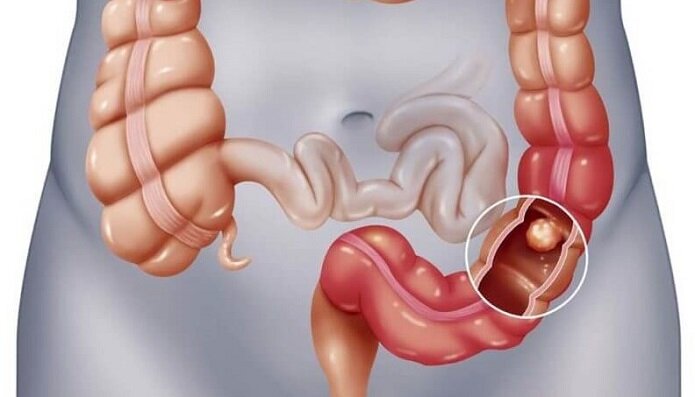 Раннее обнаружение опухоли — шанс на успех лечения