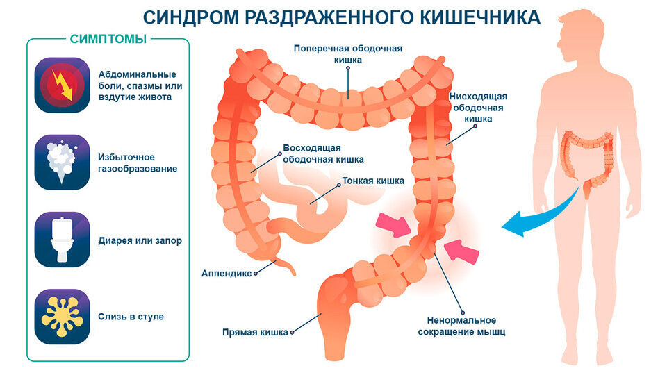 Синдром раздражённого кишечника. Синдром раздраженного кишечника рисунок.