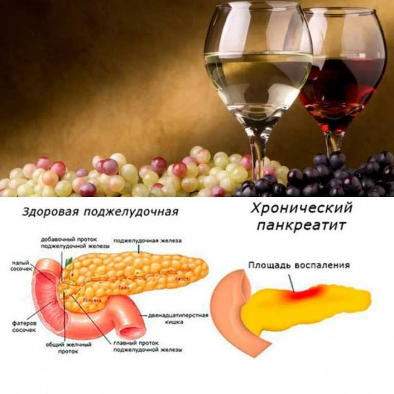 причины развития панкреатита. можно ли жить с панкреатитом. можно ли жить с панкреатитом. можно ли жить с панкреатитом. болезнь хронический панкреатит поджелудочной железы.