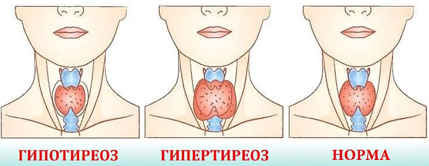 Гипотиреоз фото до и после лечения фигура