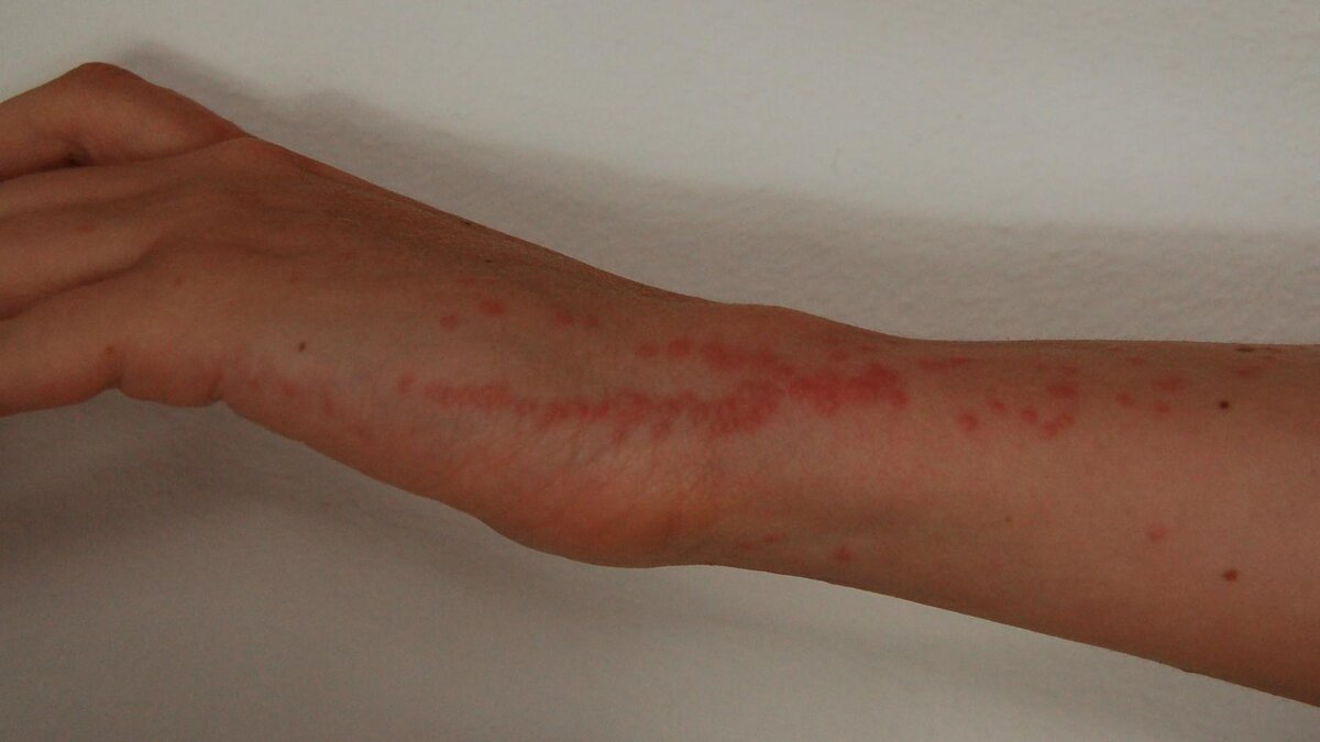 укусы клопов, фото: wikipedia.org