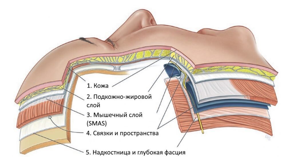 Слои лица, лифтинг Мендельсона проводится под SMAS-слоем (3) в ; слое с пересечением удерживающих лицевую маску связок