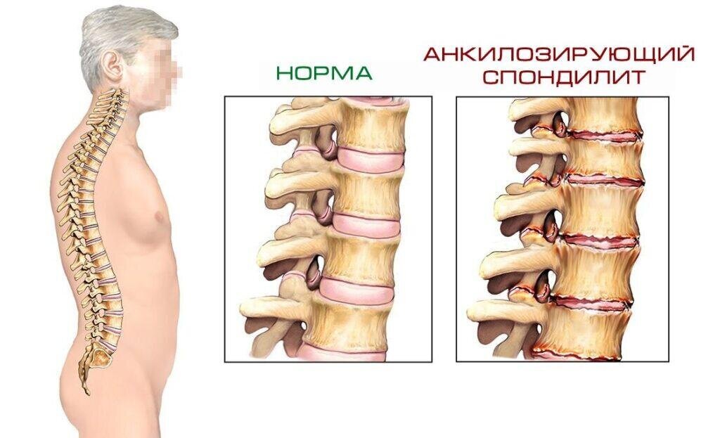 Что такое болезнь бехтерева. Анкилозирующий спондилоартрит болезнь Бехтерева. Анкилозирующий спондилит болезнь Бехтерева. Спондилит анкилозирующий поясничного отдела позвоночника. Спондилит болезнь Бехтерева.