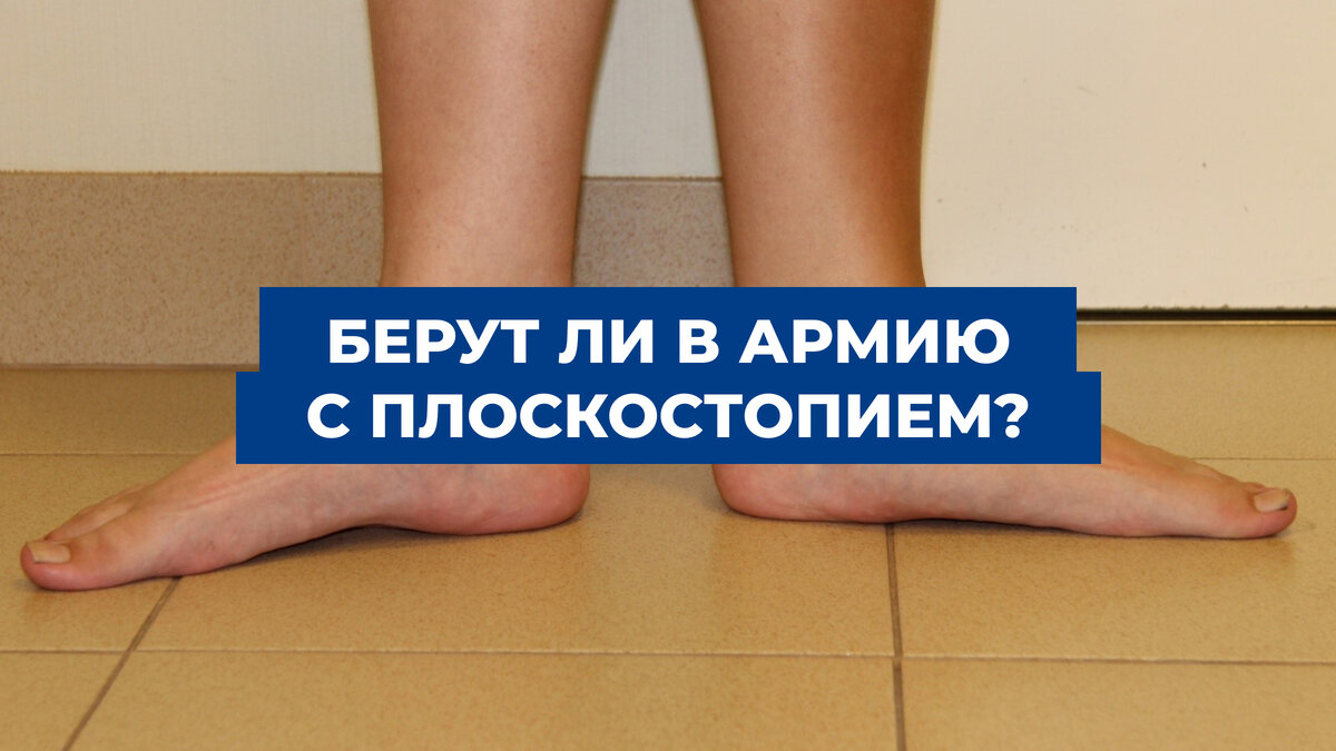 Что такое плоскостопие?