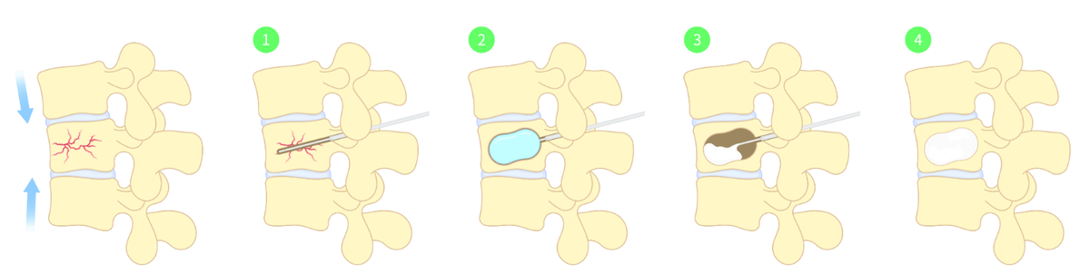 Кифопластика.