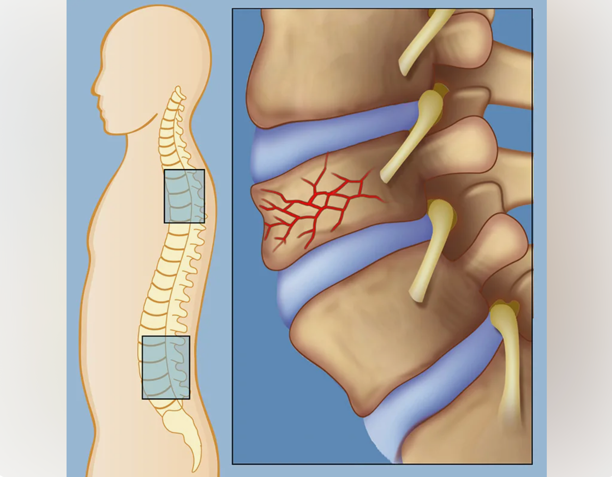Перелом позвоночника картинки