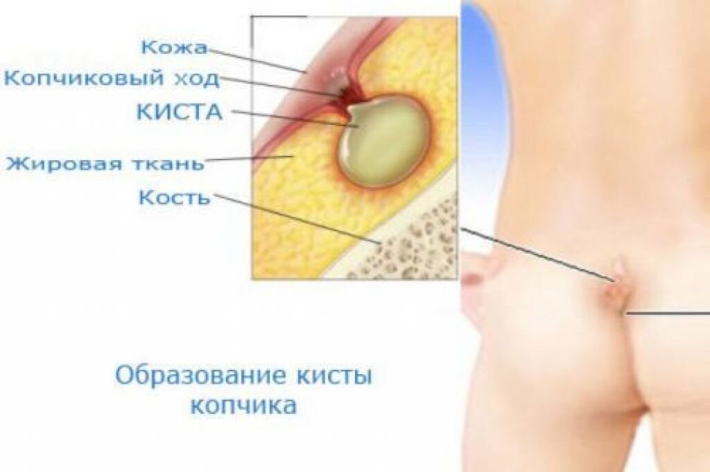 КИСТА КОПЧИКА ⁂ ЛЕЧЕНИЕ ▷ ОПЕРАЦИЯ ▷ в Киеве ▷ ФОТО ▷