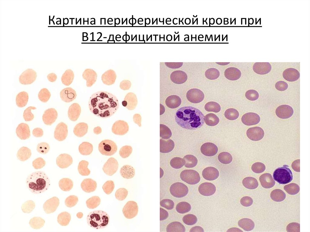 Анемия в12 дефицитная анемия картина крови