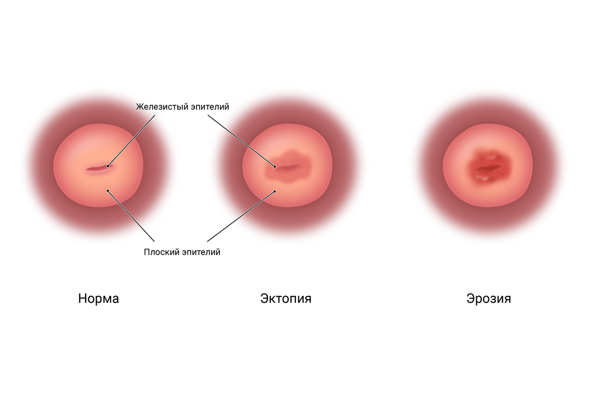 Эктопия и эрозия. Прижечь нельзя оставить | GYN37 | Дзен